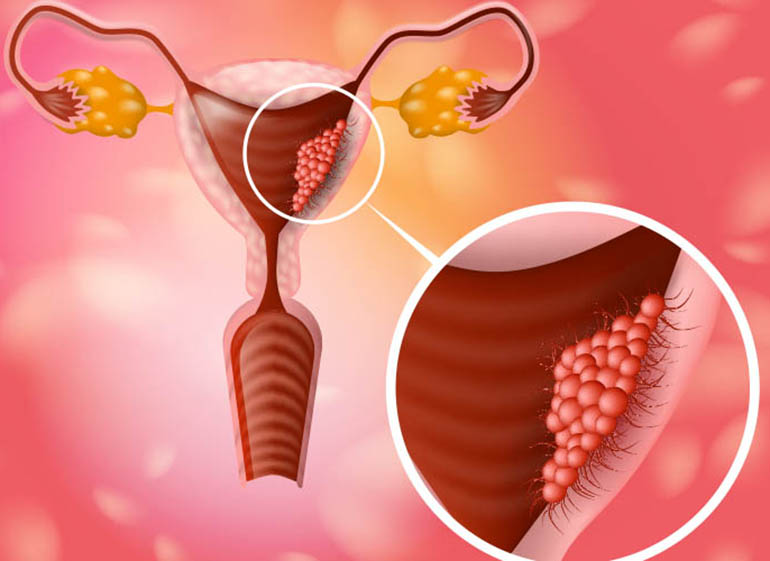 Rahim Ağzı Kanseri Nedir? Bilmeniz Gereken Temel Gerçekler