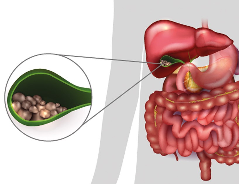 Safra Kesesi Sağlığını Korumak ve Belirtileri Tanımak