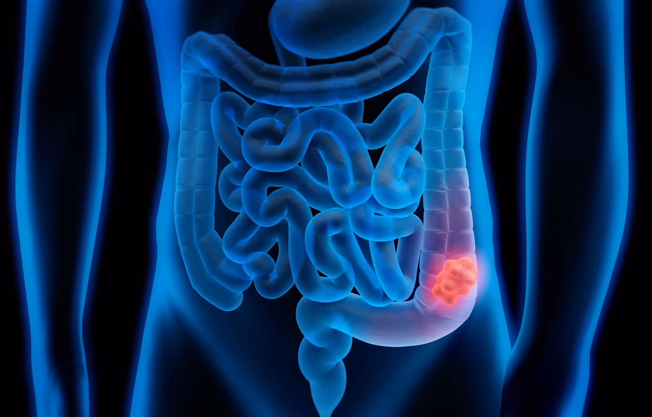 Sessiz Tehlikeye Karşı 5 Dakika: Kolon Kanseri Hakkında Bilmeniz Gerekenler