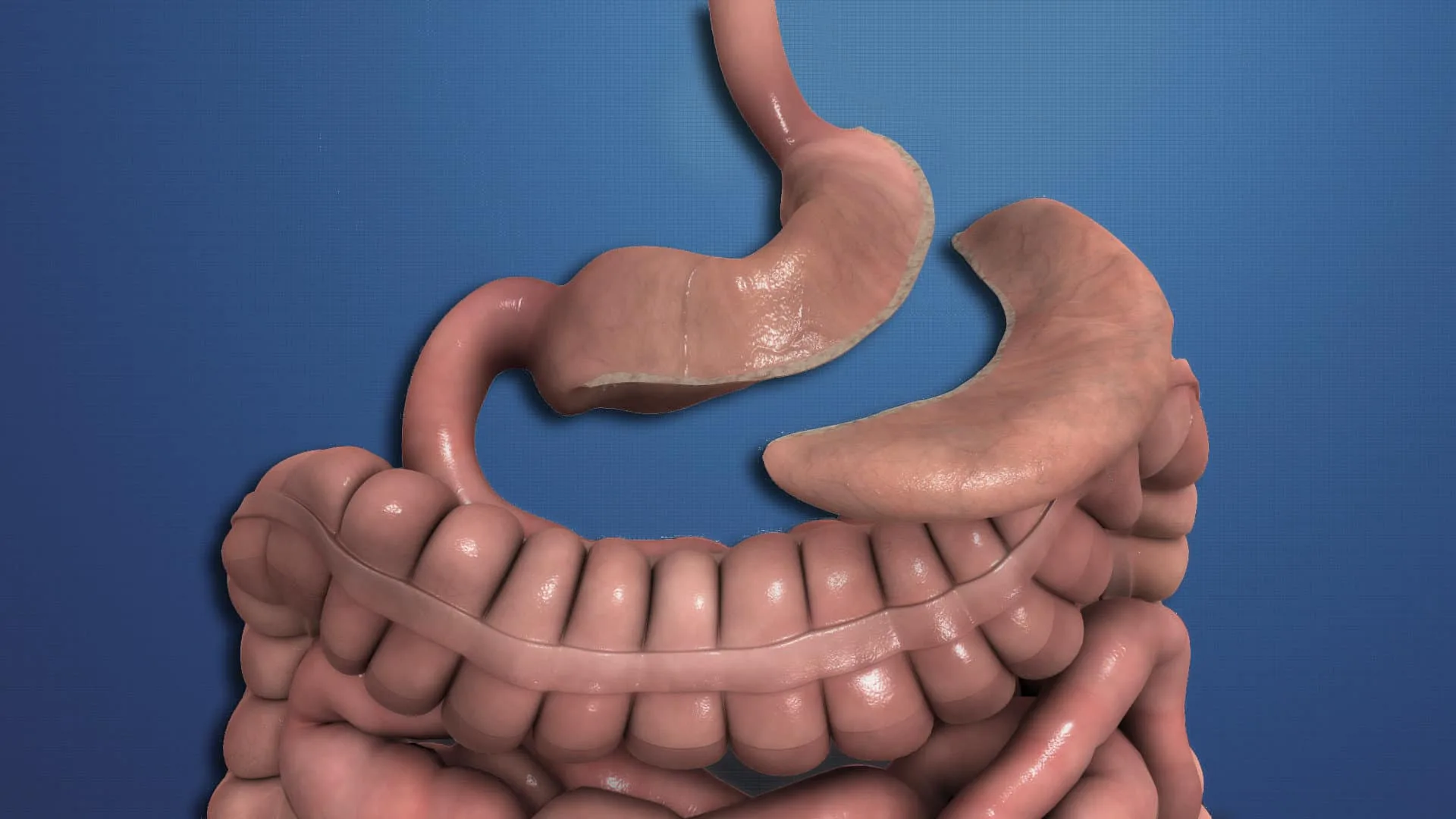 Tüp Mideden Bypass'a Dönüşüm