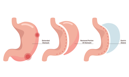 Re-Sleeve Ameliyatı