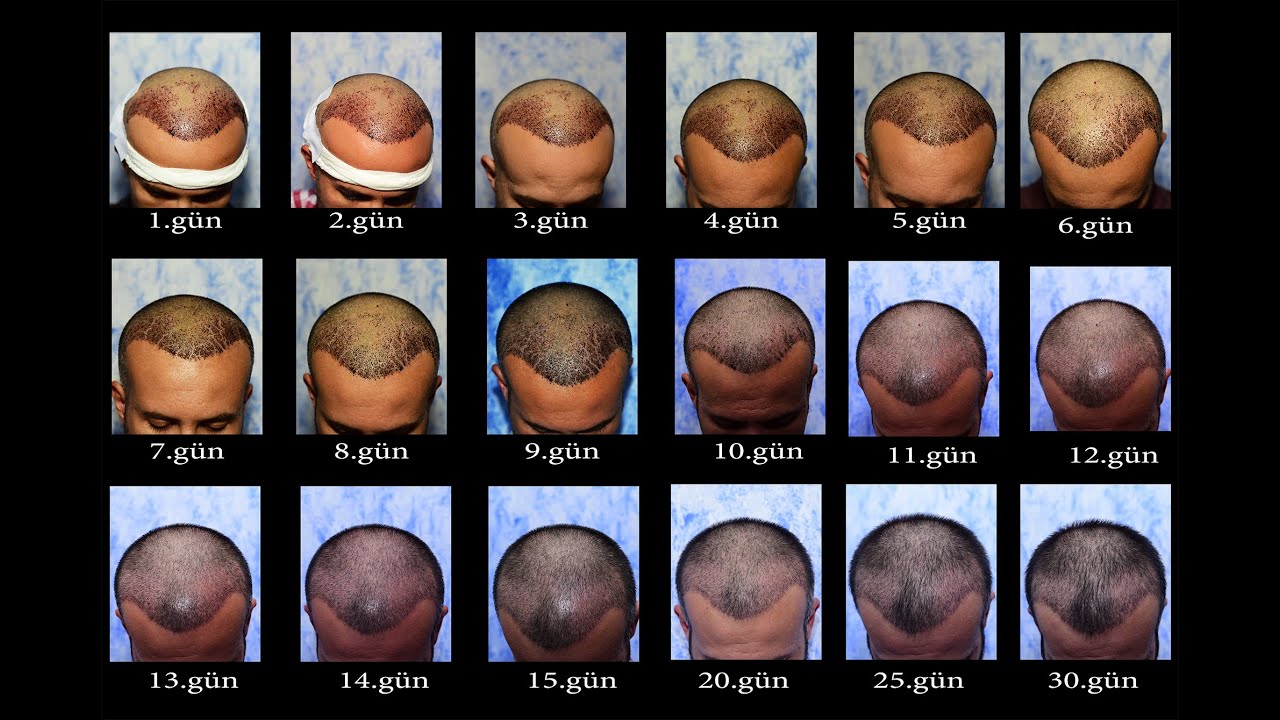 Saç Ekimi Sonrası Bakım